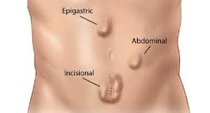 Tipos de Hernias Abdominales