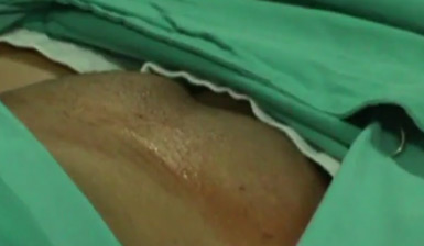 Hernia Inguinal Bilateral