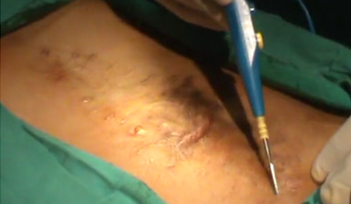 Hernia Incisional Abdominal