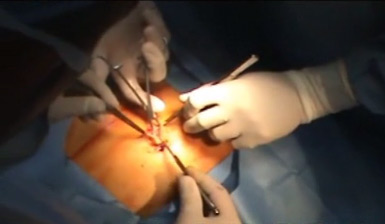 Hernia Umbilical