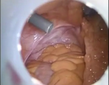 Apendice por Videolaparoscopía