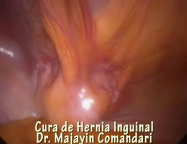 Cura de Hernia Inguinal